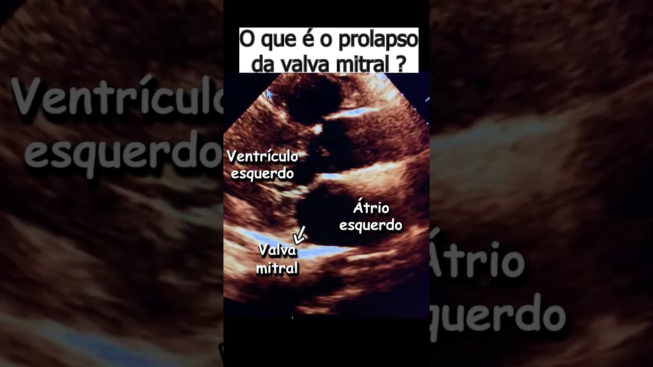 Prolapso valva mitral o que é isso?