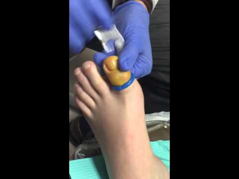 Ekzoderil atleta sa Clotrimazole cream toenail fungus