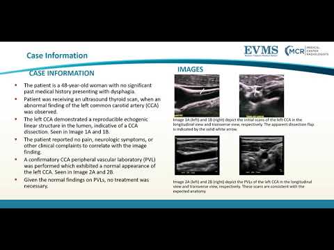 Thumbnail image of video presentation for Incidental Carotid Artery Dissection or Artifact? Understanding Mirror-Image Artifact in Ultrasonography.