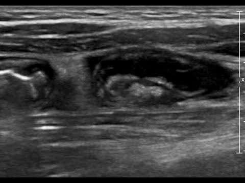 Pediatric Appendicits Ultrasound. 2/2021