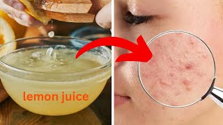 How to get rid of acne scars at home
