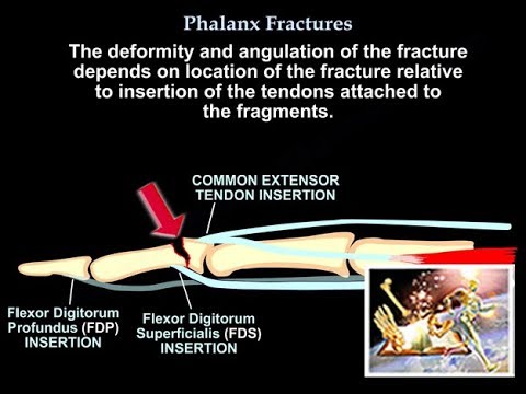 Phalanx Fractures - Everything You Need To Know - Dr. Nabil Ebraheim