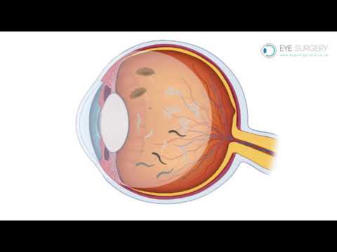 Floaters and Posterior Vitreous Detachment (PVD)
