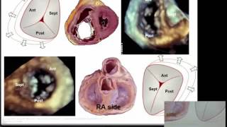 Echocardiographic assessment of the tricuspid valve – Dr Lisa Walters