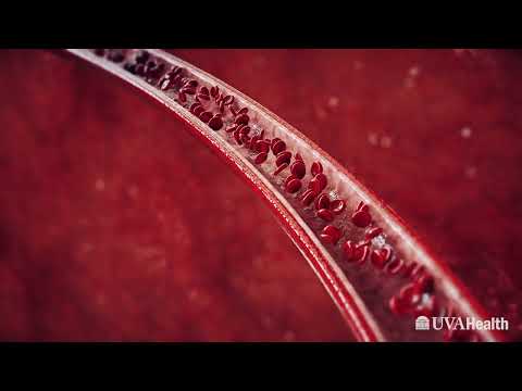 Atherosclerosis: Narrowing of the Arteries