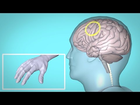 Repetitive Transcranial Magnetic Stimulation (rTMS) and Hand Therapy