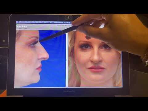 Nasal Analysis for Rhinoplasty with Dr. Jordan Rihani