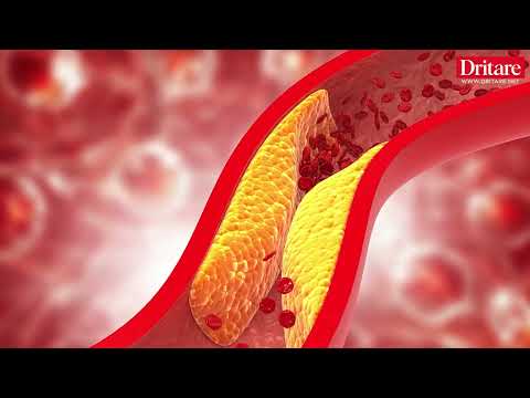 Ateroskleroza, vrasësi i heshtur dhe sekreti i jetëgjatësisë i fshehur në arteriet tona!