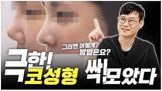 [휴먼성형외과] 역대급 어려운 극한!코성형 다 모았음! 원인부터 수술 방법까지 자세히 알아보자!