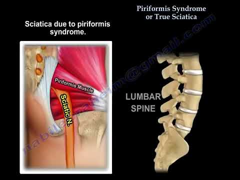 Piriformis-Syndrom vs. Bandscheibenvorfall: Entschlüsselung der herausfordernden Präsentation