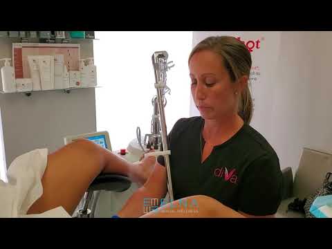 O Shot Diva laxity, Steinberg Urology Montreal