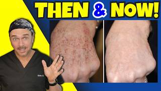Erasing Years Of Skin Damage Anywhere In Minutes!