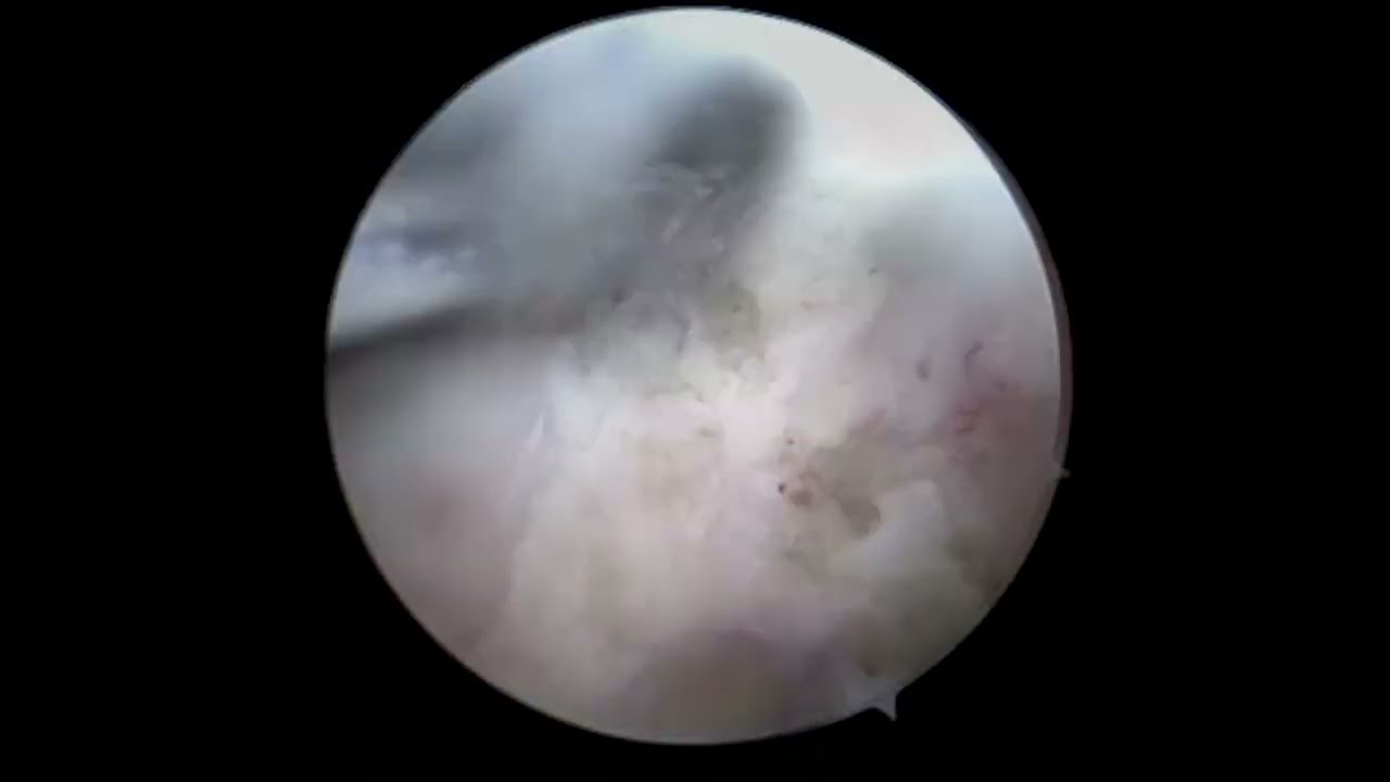 Biceps Tendon Transfer 2025