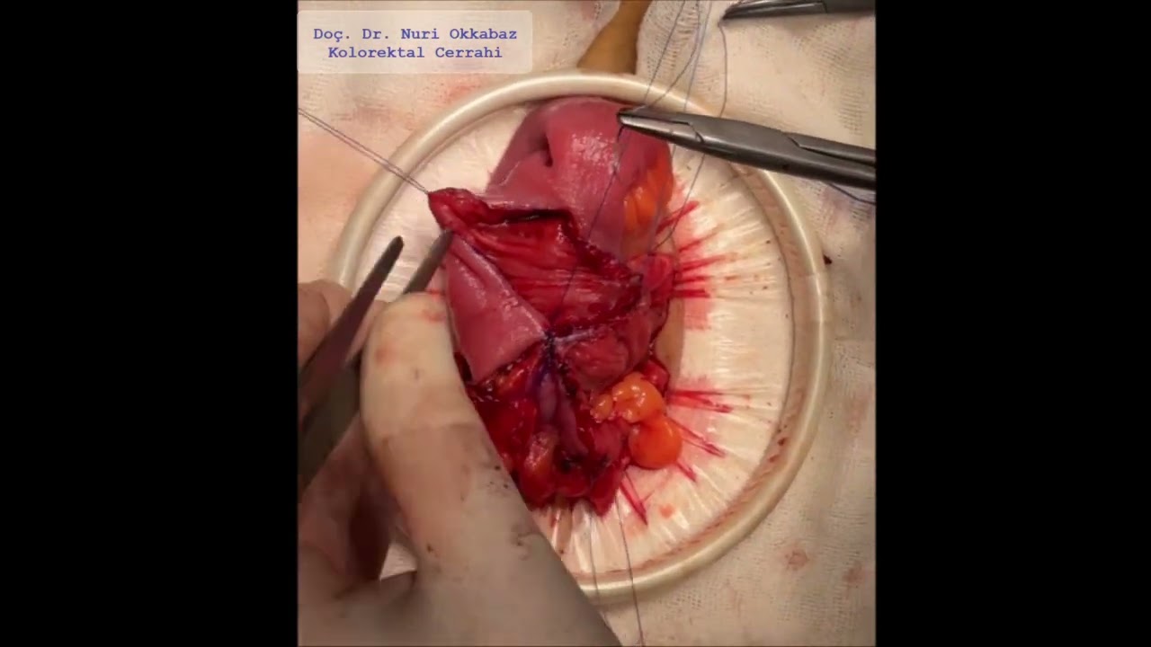 Kono-S Anastomosis Following Laparoscopic Ileocecal Resection for Crohn’s Disease
