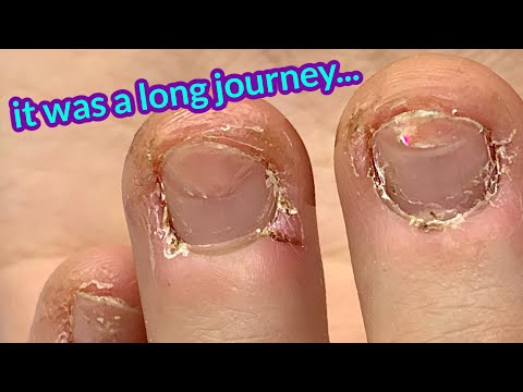 Bitten Nails Transformation – 2 years later! Anna’s Last fill 😢