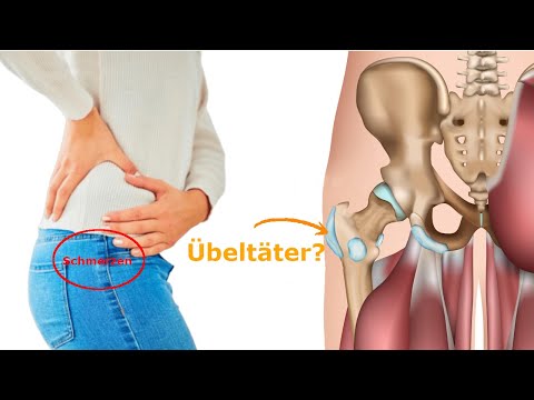 Seitliche Hüftschmerzen - ist wirklich der SCHLEIMBEUTEL schuld?