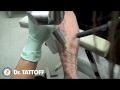 odstranenie tetovania (slipknot) - Známka: 2, váha: malá