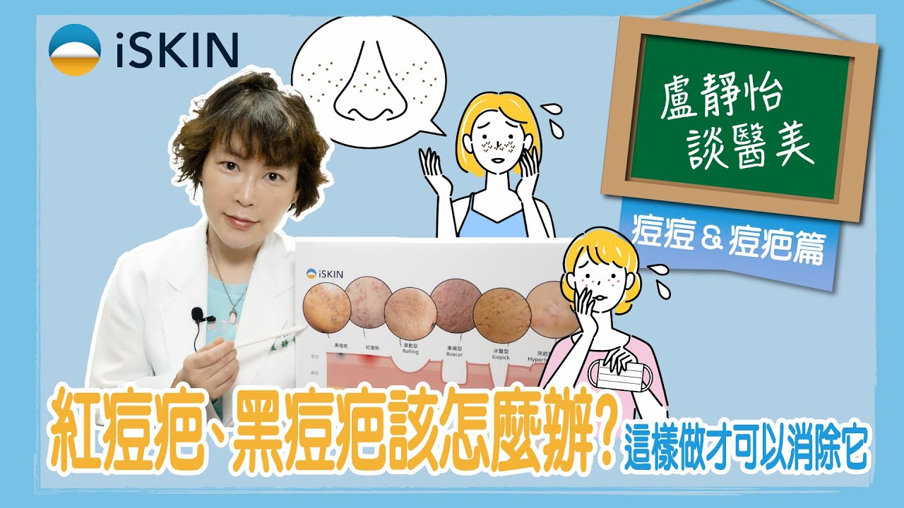 常見的 4 種痘疤！討厭的紅痘疤、黑痘疤要怎麼做才可以消除？｜盧靜怡醫師