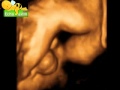 Echographie 3D Sexe Masculin C Est Un Garcon