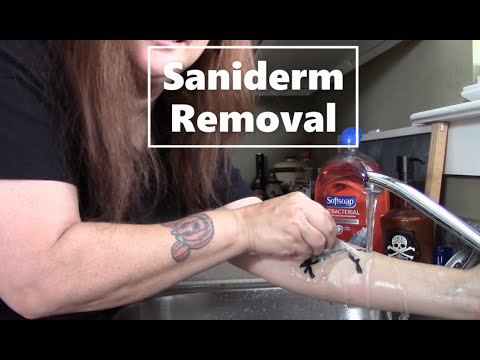 Saniderm Removal