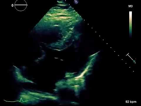 A left ventricular ejection fraction of 70% and a trivial pericardial effusion