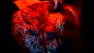 Cancerslug demighoul and me