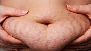 How to Get Rid of Stretch Marks Fast - Get Rid of Stretch Marks Naturally