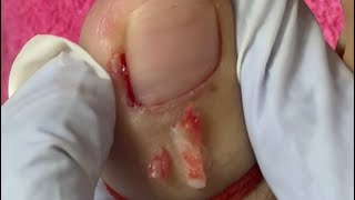 Ep_8842 Foot nails skin removal 👣 อย่าปล่อยให้มันหนาสะสม 😅 (clip from Thailand)