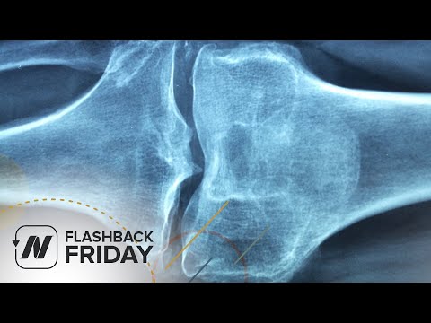 Az artritisz és a boka ízületi tünetei