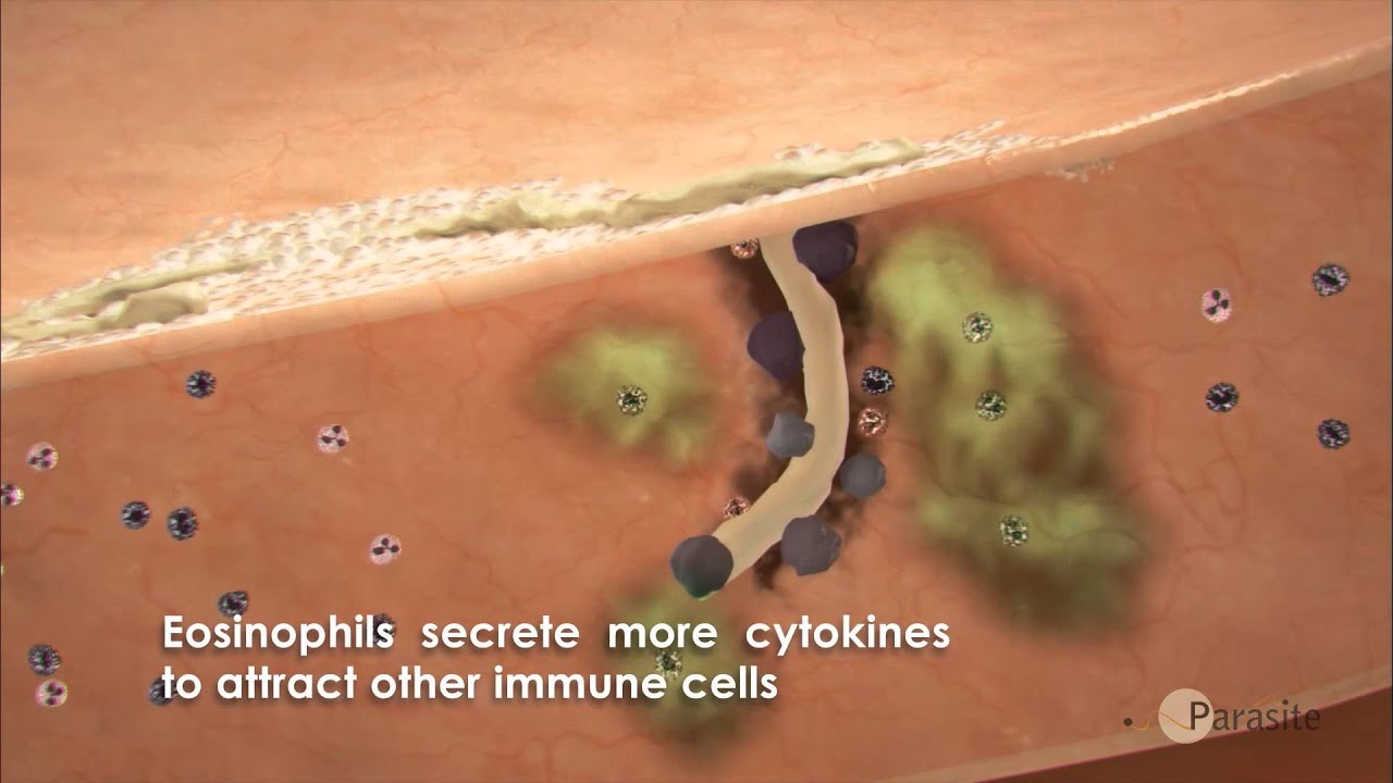 Human infection and immune response to Anisakis - YouTube