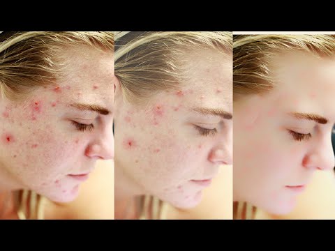 How to cure pigmentation,antiageing,dryness || 2weeks get clear glowing skin