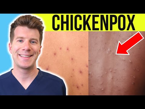 Doctor explains CHICKENPOX | Causes, Stages, Symptoms, Treatment (PLUS PHOTOS)