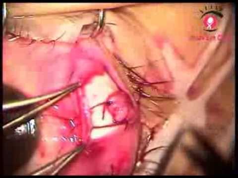 Adjustable Squint Surgery (Sliding noose) by Squint Specialist in Mumbai