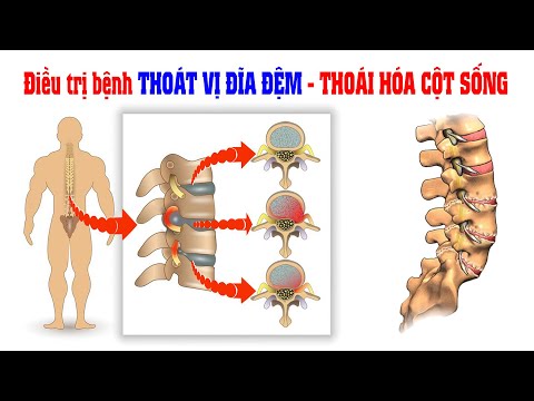 Điều trị bệnh THOÁT VỊ ĐĨA ĐỆM - THOÁI HÓA CỘT SỐNG