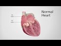 Normal Heart Vs Heart In AFib