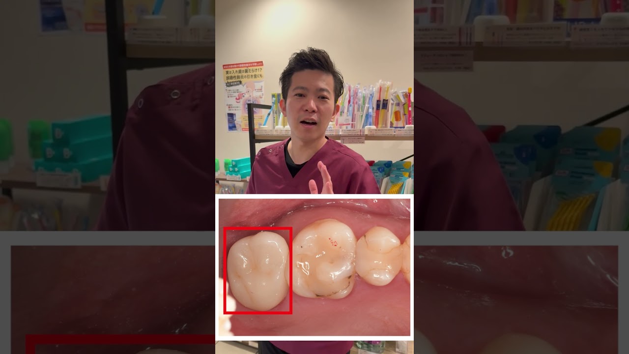 親知らずを他の歯に移植！その歯、インプラントや入れ歯にしなくても良いかも！ #親しみやすい歯医者 #虫歯#親知らず#インプラント#入れ歯