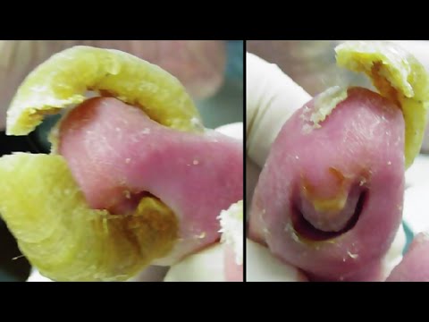 Paano alisin kuko halamang-singaw Lunas para sa mga halamang-singaw sa larawan banyo