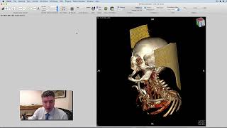 Remoção de osso (caveirinha)