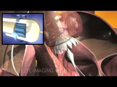 Heart Valve Implantation (Detailed Valve Deployment) - Medical & Scientific Video Production