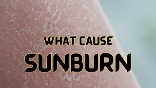 What cause sunburn