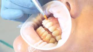 Carillas dentales de composite - Dra. Ana Cabeza Martínez