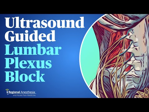 Ultrasound-Guided Lumbar Plexus Block