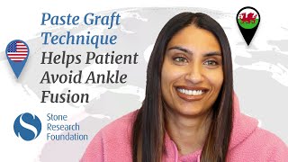 Unlocking Mobility: Natasha's Remarkable Ankle Restoration with the Articular Cartilage Paste Graft