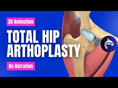Total Hip Replacement (Arthroplasty) - 3D Animation (No Narration)