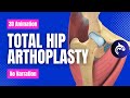 Total Hip Replacement Arthroplasty 3D Animation No Narration