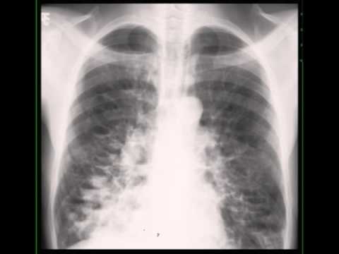Cystic Bronchiectasis on Chest X ray