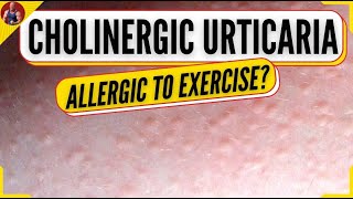 Allergic Reaction To Exercise - Cholinergic Urticaria - Exercise Induced Hives