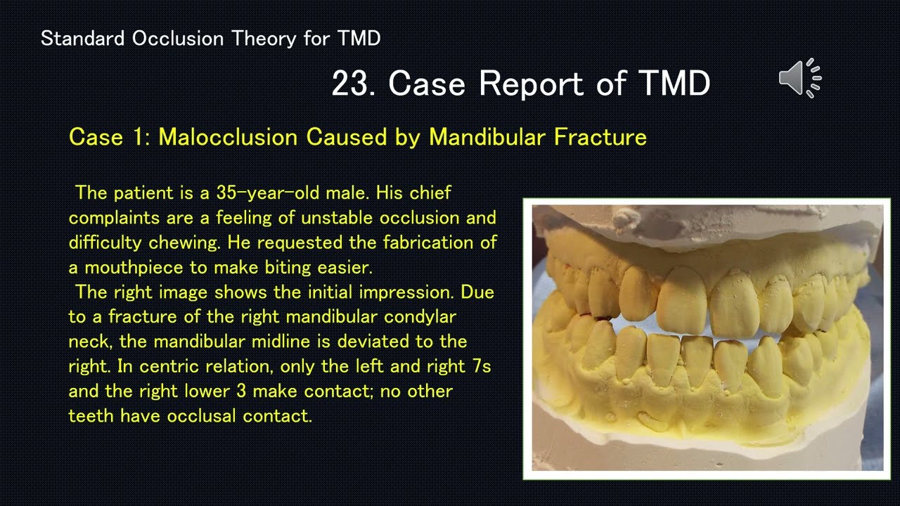 23. Case Report of TMD