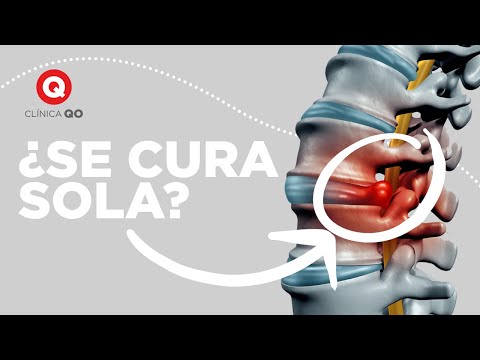 La HERNIA DISCAL ¿se CURA sola?
