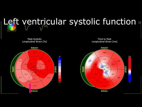 Echocardiography GLS -14% Global Longitudinal Strain Heart Failure EF40% BEFORE Anticancer Treatment